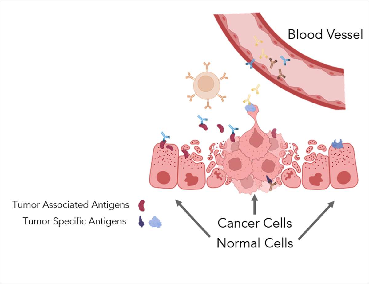 Autoantibodies: Powerful Biomarkers in Cancer Precision Medicine